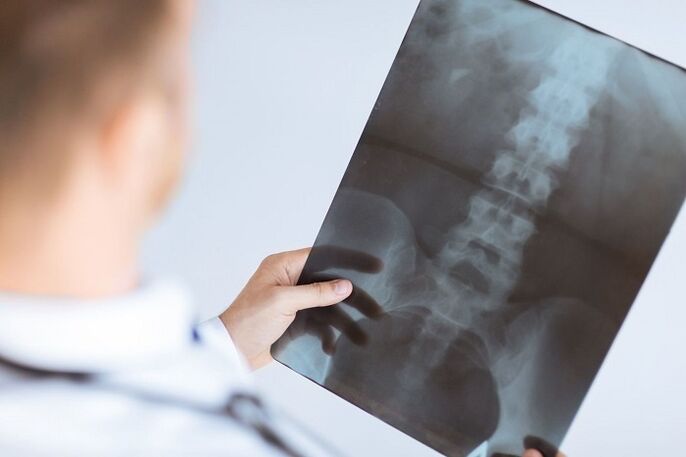 Diagnoseoptionen für Lumbalosteochondrose