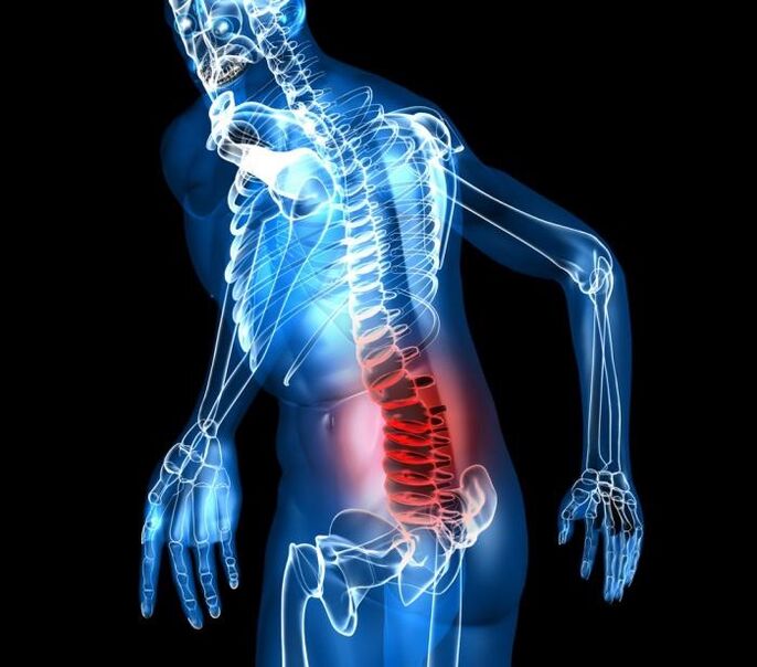 Grad- und Entwicklungsphasen der lumbalen Osteochondrose