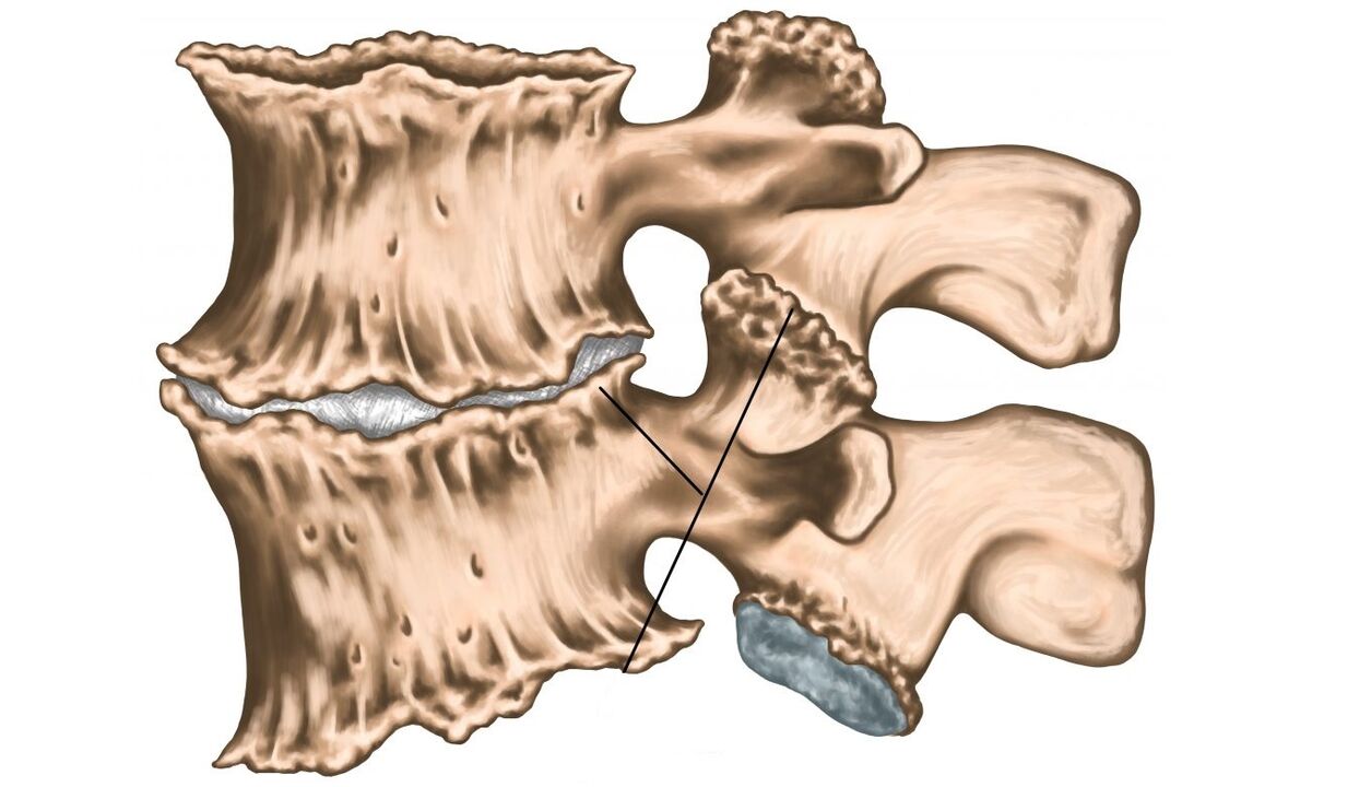 Wirbelsäulenläsionen aufgrund von Osteochondrose