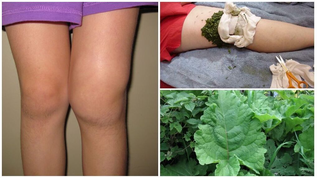 Mit Klette auf das Knie komprimieren – eine Volksmethode zur Behandlung von Gonarthrose