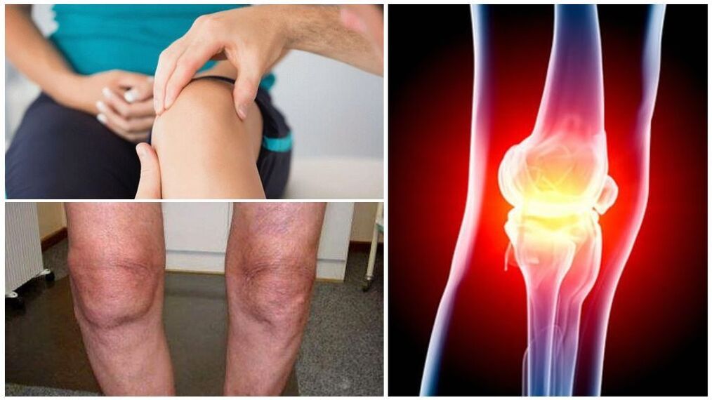 Symptome einer Arthrose des Kniegelenks