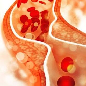 Die Ablagerung von Cholesterin an den Innenwänden der Blutgefäße führt zu Schmerzen im Nackenbereich
